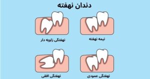 دندان عقل نهفته