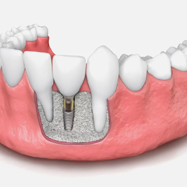 پیوند استخوان در ایمپلنت دندان