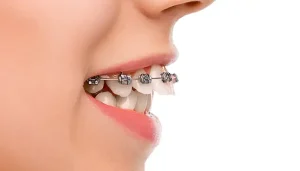 دندان خرگوشی