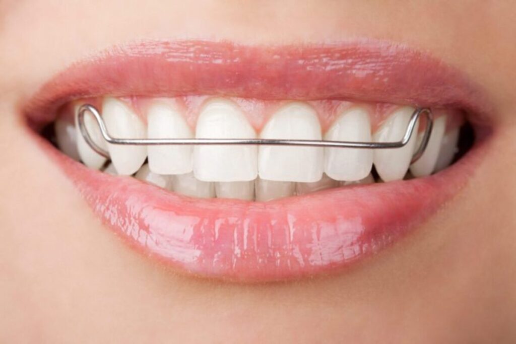 ارتودنسی متحرک بهتر است یا ثابت؟