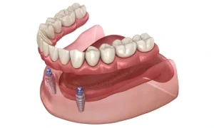 دندان مصنوعی ثابت بهتر است یا متحرک؟