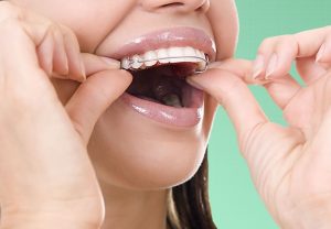 ارتودنسی متحرک بهتر است یا ثابت؟