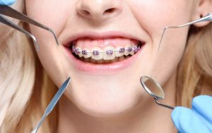 ارتودنسی متحرک بهتر است یا ثابت؟
